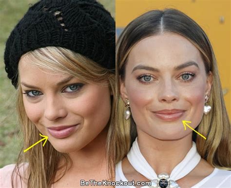 margot robbie lip fillers